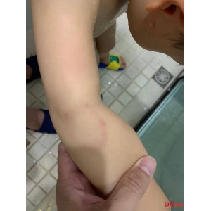 温州3岁男童在国际幼儿园受伤，园方被判赔5000